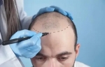 Why Choose Hair Transplants in Islamabad for Thicker Hair